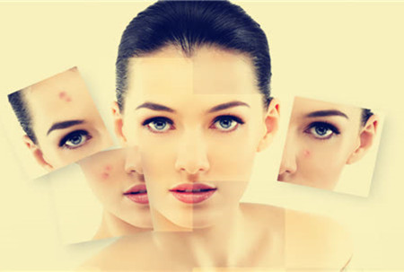 祛痘也要將就方法，不然后果很嚴重