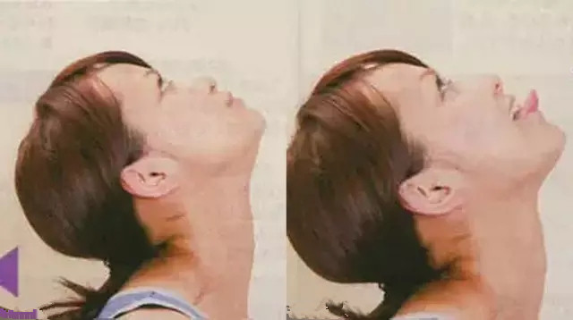 怎樣變成瓜子臉不整容 怎樣變成瓜子臉不整容