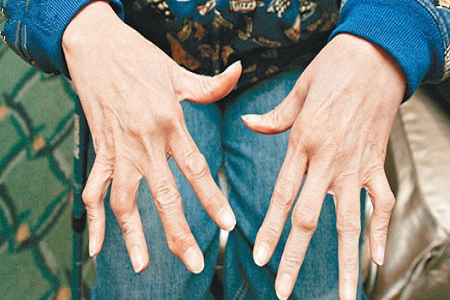 中醫(yī)治療風(fēng)濕病的基本常識需知曉 中醫(yī)治療風(fēng)濕病的基本常識需知曉