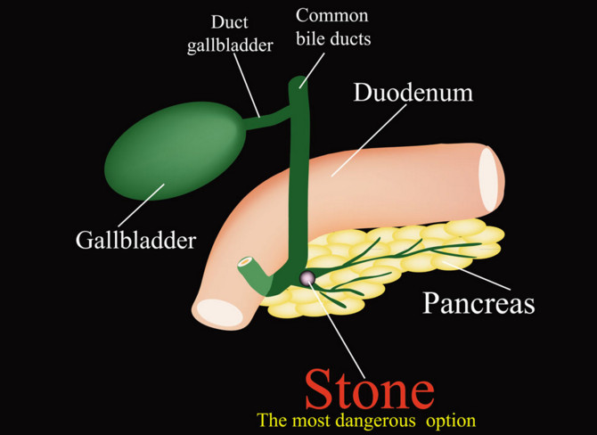 吃早餐可以預(yù)防膽結(jié)石形成的原因 吃早餐可以預(yù)防膽結(jié)石形成的原因