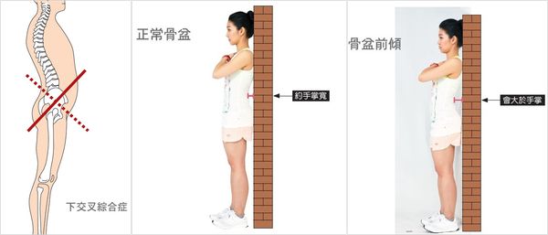 骨盆前傾怎么矯正 強化腹部的核心肌群 骨盆前傾怎么矯正 強化腹部的核心肌群