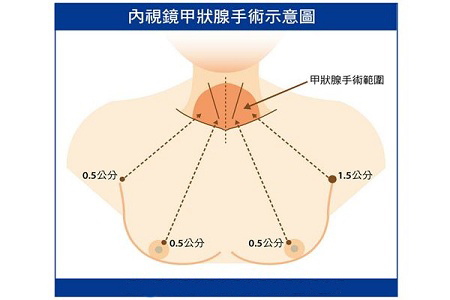 脖子不留疤 從乳暈切除甲狀腺腫瘤 脖子不留疤 從乳暈切除甲狀腺腫瘤