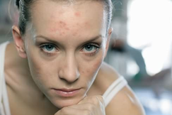 懷孕了孕婦長痤瘡怎么辦如何防止.png 懷孕了孕婦長痤瘡怎么辦如何防止.png