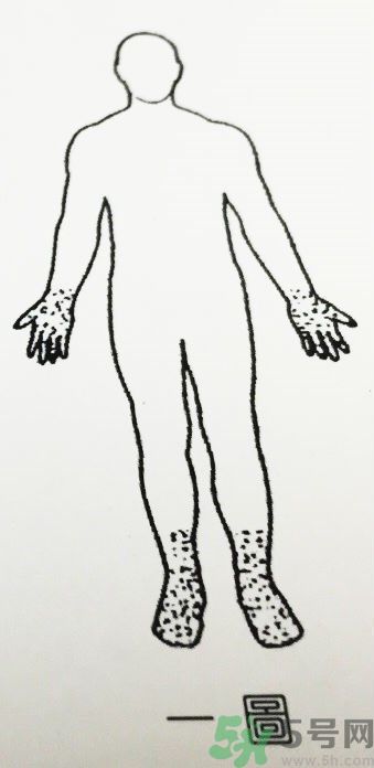 經(jīng)常手麻腳麻是怎么回事 4種疾病的前兆 經(jīng)常手麻腳麻是怎么回事 4種疾病的前兆