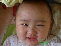 12歲身上長(zhǎng)了很多紅點(diǎn)怎么回事?長(zhǎng)了水痘怎么辦?.png 12歲身上長(zhǎng)了很多紅點(diǎn)怎么回事?長(zhǎng)了水痘怎么辦?.png