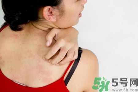 我15歲皮膚過敏怎么辦?15歲皮膚過敏能自愈嗎? 我15歲皮膚過敏怎么辦?15歲皮膚過敏能自愈嗎?