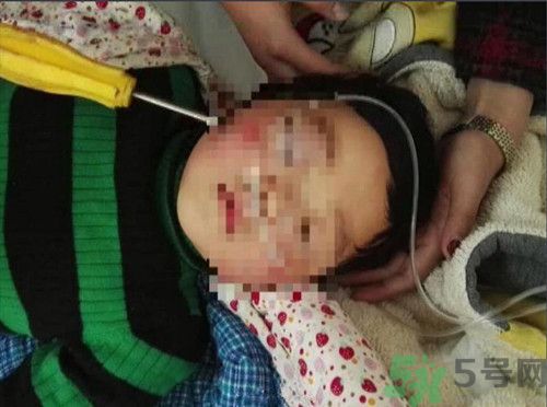 螺絲刀插入一歲女童頭部 螺絲刀插入一歲女童頭部