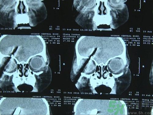 螺絲刀插入一歲女童頭部 螺絲刀插入一歲女童頭部