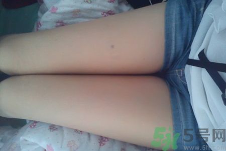 大腿上長(zhǎng)痘痘怎么回事?為什么我大腿上長(zhǎng)痘痘 大腿上長(zhǎng)痘痘怎么回事?為什么我大腿上長(zhǎng)痘痘