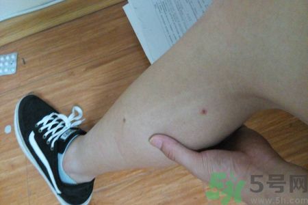 大腿上長(zhǎng)痘痘怎么回事?為什么我大腿上長(zhǎng)痘痘 大腿上長(zhǎng)痘痘怎么回事?為什么我大腿上長(zhǎng)痘痘