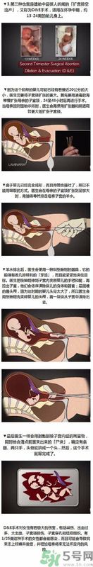 墮胎手術(shù)的可怕細(xì)節(jié) 墮胎手術(shù)的可怕細(xì)節(jié)