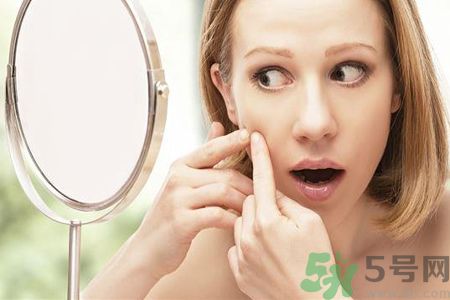 痘痘應(yīng)該擠掉嗎?痘痘到底要不要擠掉? 痘痘應(yīng)該擠掉嗎?痘痘到底要不要擠掉?