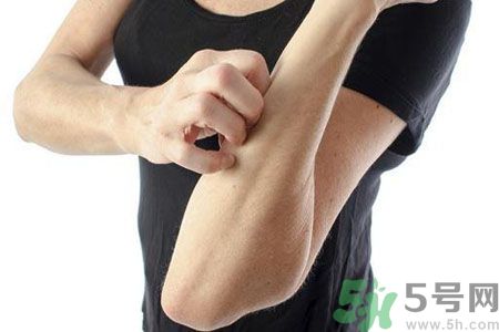 皮膚炎癢是怎么回事？皮膚炎發(fā)作怎么治療？