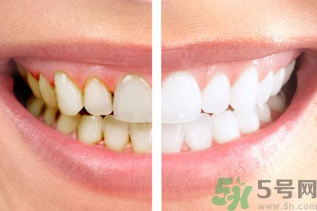 牙齒有黃斑怎么辦？牙齒有黃斑怎么去除？
