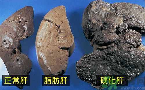 得了脂肪肝該怎么治？脂肪肝對人體危害有多大？