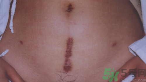 剖腹產(chǎn)疤痕怎么修復(fù)?剖腹產(chǎn)如何護(hù)理不留疤痕?.jpg 剖腹產(chǎn)疤痕怎么修復(fù)?剖腹產(chǎn)如何護(hù)理不留疤痕?.jpg