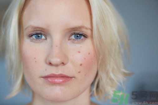 為什么會長痘痘？痘痘有哪幾種類型的？