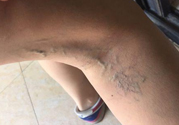 40歲女性小腿靜脈曲張怎么辦？
