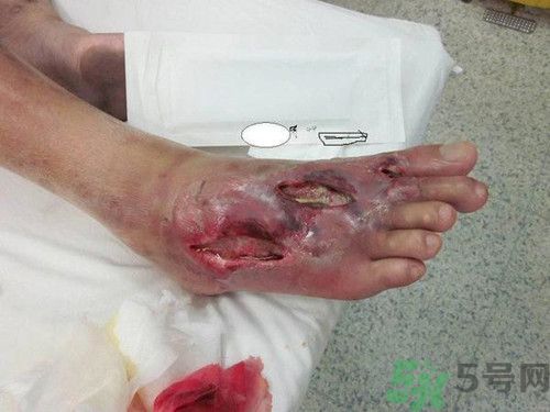 戒煙嗑瓜子嗑出糖尿病足,糖尿病足的早期癥狀有哪些? 戒煙嗑瓜子嗑出糖尿病足,糖尿病足的早期癥狀有哪些?