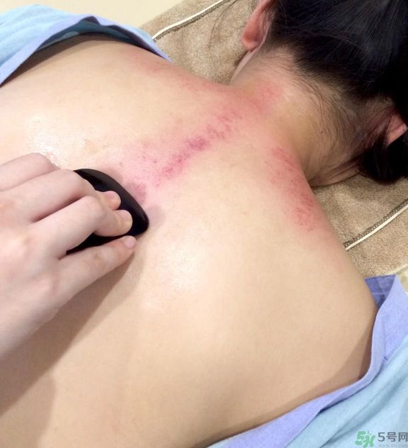 刮痧的好處有那些？夏季刮痧要注意什么？