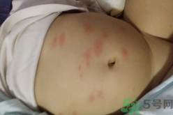 孕婦肚子上長紅點(diǎn)點(diǎn)是怎么回事?孕婦肚子上長紅點(diǎn)點(diǎn)怎么辦?.png