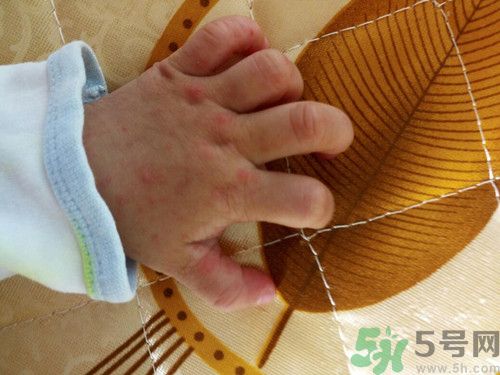 手足口病怎么治療?手足口病初期癥狀 手足口病怎么治療?手足口病初期癥狀