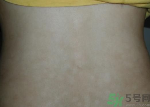 花露水可以治汗斑嗎?花露水能根治汗斑嗎? 花露水可以治汗斑嗎?花露水能根治汗斑嗎?