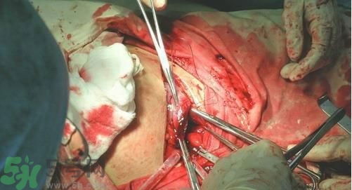 剖腹產(chǎn)傷口多久愈合?剖腹產(chǎn)傷口怎么恢復(fù)的快 剖腹產(chǎn)傷口多久愈合?剖腹產(chǎn)傷口怎么恢復(fù)的快