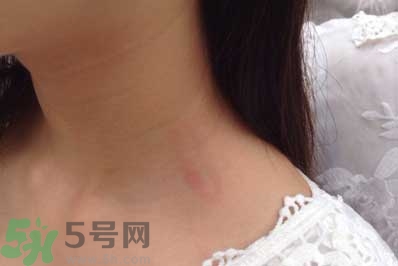 種草莓吻痕是什么意思？吻痕是怎么弄出來的？