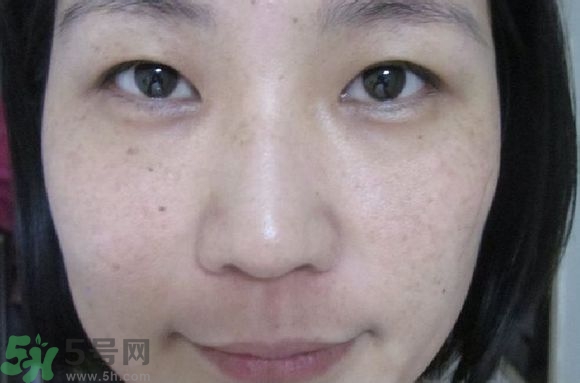 肝斑是肝有問題嗎?肝斑怎么調(diào)理簡單方法 肝斑是肝有問題嗎?肝斑怎么調(diào)理簡單方法