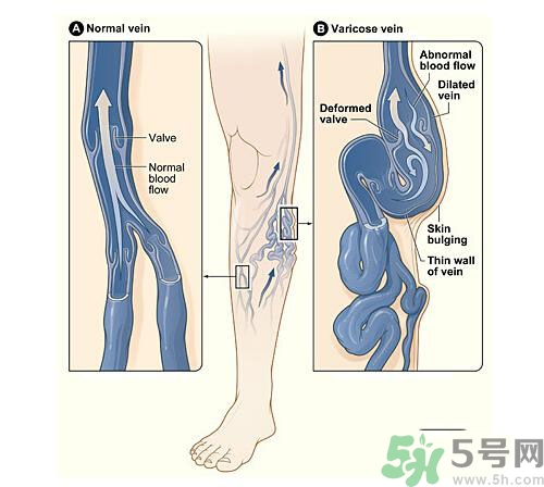 靜脈曲張?jiān)缙诎Y狀有哪些？靜脈曲張?jiān)缙诎Y狀