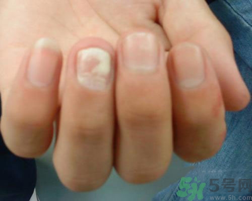 指甲發(fā)白是怎么回事？指甲發(fā)白代表什么？