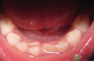 雙排牙是什么?雙排牙的危害 雙排牙是什么?雙排牙的危害