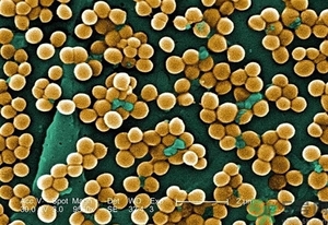 裂谷熱病癥狀有哪些?裂谷熱病的早期癥狀 裂谷熱病癥狀有哪些?裂谷熱病的早期癥狀