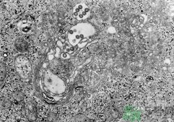 裂谷熱病怎么治？裂谷熱病的癥狀有哪些？