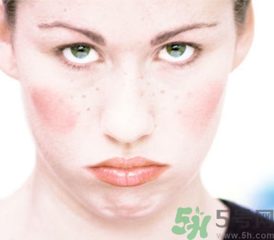 夏季流汗臉癢怎么回事？夏季臉癢怎么辦？