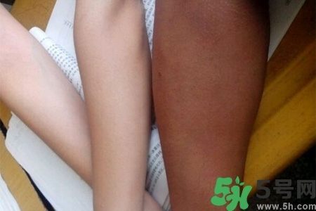 腿曬黑了怎么白回來？腿曬黑了怎么辦？