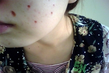 激光點痣后可以洗臉嗎？激光點痣后需要注意什么？