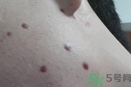 激光點痣后可以洗臉嗎？激光點痣后需要注意什么？