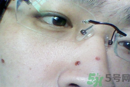 激光點(diǎn)痣后可以洗臉嗎？激光點(diǎn)痣后需要注意什么？