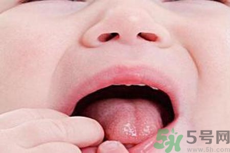 寶寶口腔潰瘍?cè)趺崔k？治療寶寶口腔潰瘍方法有什么？