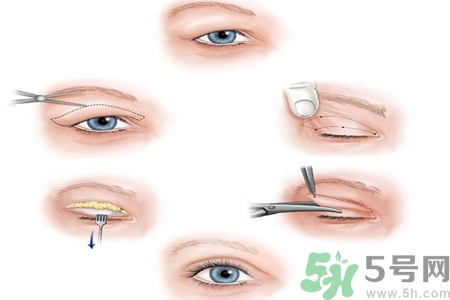 割雙眼皮分哪幾種？割雙眼皮需要多少錢？
