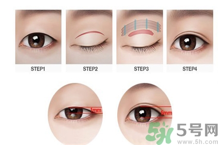 割雙眼皮分哪幾種？割雙眼皮需要多少錢？