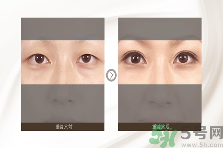 割雙眼皮分哪幾種？割雙眼皮需要多少錢(qián)？