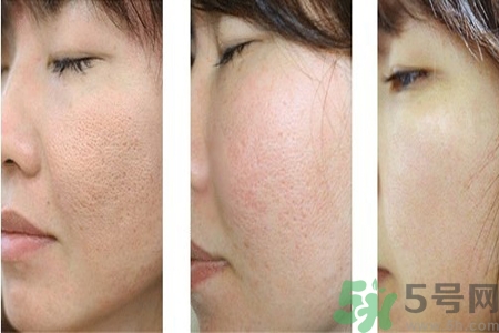 皮膚毛孔粗大原因有哪些？如何預防皮膚毛孔粗大？