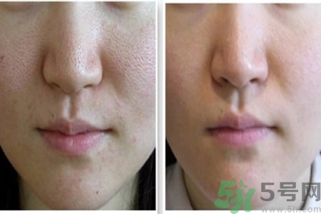 皮膚毛孔粗大原因有哪些？如何預防皮膚毛孔粗大？