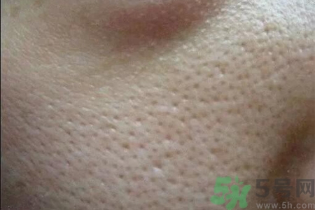 皮膚毛孔粗大原因有哪些？如何預(yù)防皮膚毛孔粗大？
