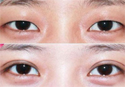 割雙眼皮分哪幾種？割雙眼皮需要多少錢？