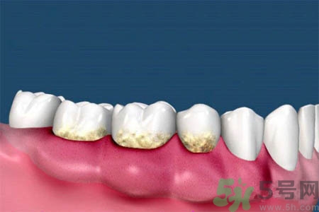 哪些人不能洗牙？洗牙需要注意什么？