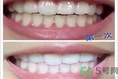 冷光美白牙齒的價(jià)格是多少？做冷光美白牙齒需要多少錢？